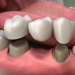 Private: Understanding the Basics About Dental Crowns and Dental Bridges